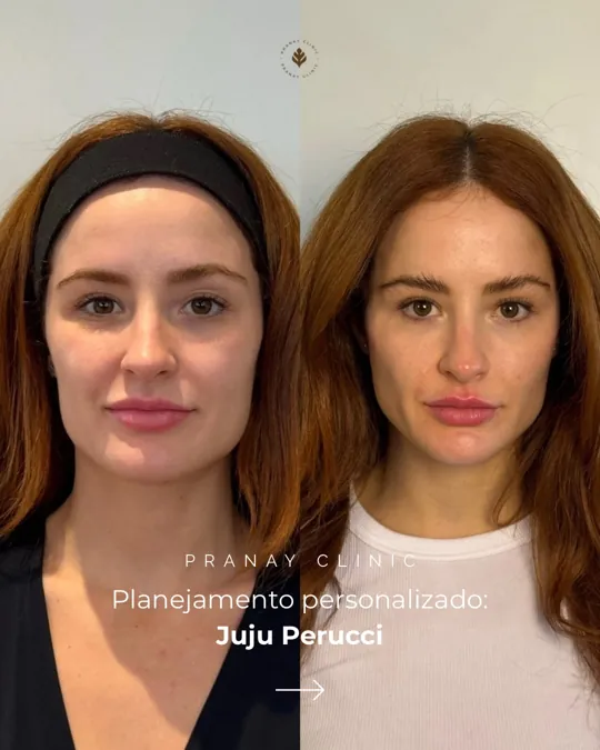 Paciente antes e depois do planejamento personalizado