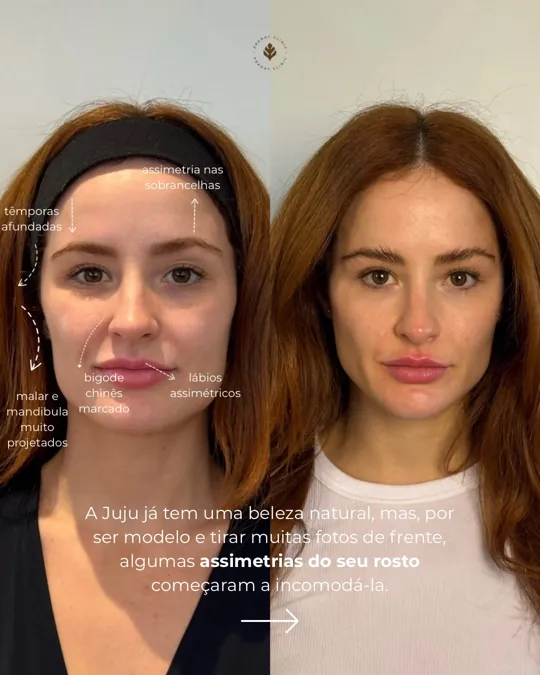 Pontos do rosto que foram avaliados no planejamento